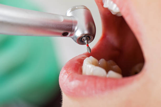 Best Chipped Tooth Repair Near Me  in Mccaysville, GA